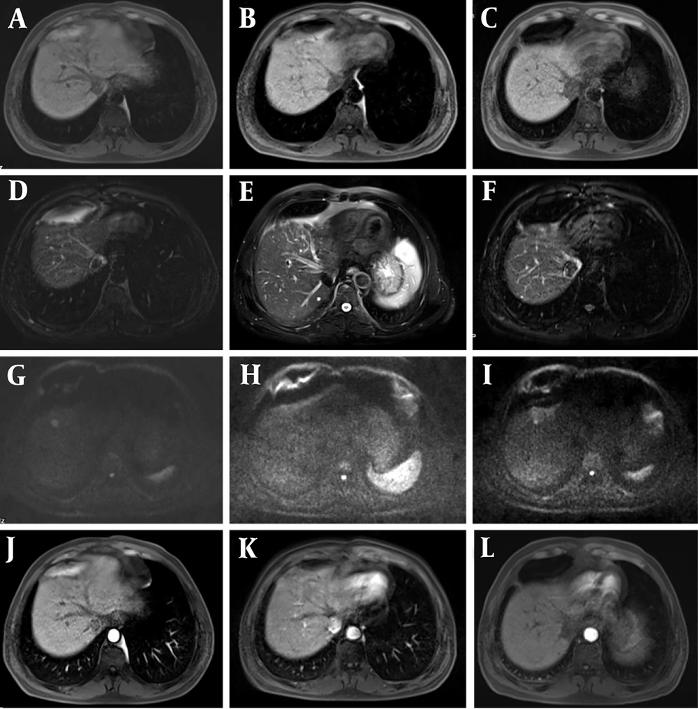 Transcatheter arterial chemoembolization (TACE) + radiofrequency ablation (RFA) observation was performed 2 months after surgery. After 12 months of follow-up, recurrence of the intervention lesion was found. A - C, phase III T1-weighted imaging (T1WI) (recurrence, suspicious, and postoperative groups); D - F, phase III T2-weighted imaging (T2WI) images; G - I, diffusion-weighted imaging (DWI) phase III images; J - L, LAVE enhanced arterial phase three phase images. DWI was sensitive to residual and recurrent lesions, so it presented slightly higher mixed signal shadows. Transcatheter arterial chemoembolization (TACE) + radiofrequency ablation (RFA) observation was performed 2 months after surgery. After 12 months of follow-up, recurrence of the intervention lesion was found. A - C, phase III T1-weighted imaging (T1WI) (recurrence, suspicious, and postoperative groups); D - F, phase III T2-weighted imaging (T2WI) images; G - I, diffusion-weighted imaging (DWI) phase III images; J - L, LAVE enhanced arterial phase three phase images. DWI was sensitive to residual and recurrent lesions, so it presented slightly higher mixed signal shadows.