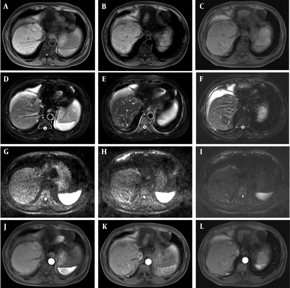 Five months after transcatheter arterial chemoembolization (TACE), a recurrence of the lesion was detected and radiofrequency ablation (RFA) surgery was added. One month after surgery, the patient was enrolled for follow-up, and a recurrence of the interventional lesion was found after 15 months of follow-up. A - C, phase III T1-weighted imaging (T1WI) (recurrence, suspicious, and postoperative groups); D - F, phase III T2-weighted imaging (T2WI) images; G - I, diffusion-weighted imaging (DWI) phase III images; J - L, LAVE enhanced arterial phase three phase images. After TACE combined with RFA surgery, the lesion would shrink over time, and if the lesion increased during follow-up, there was also a high suspicion of local recurrence. Five months after transcatheter arterial chemoembolization (TACE), a recurrence of the lesion was detected and radiofrequency ablation (RFA) surgery was added. One month after surgery, the patient was enrolled for follow-up, and a recurrence of the interventional lesion was found after 15 months of follow-up. A - C, phase III T1-weighted imaging (T1WI) (recurrence, suspicious, and postoperative groups); D - F, phase III T2-weighted imaging (T2WI) images; G - I, diffusion-weighted imaging (DWI) phase III images; J - L, LAVE enhanced arterial phase three phase images. After TACE combined with RFA surgery, the lesion would shrink over time, and if the lesion increased during follow-up, there was also a high suspicion of local recurrence.