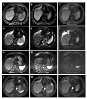 Application of Multimodal Magnetic Resonance Imaging in Postoperative Evaluation of Hepatocellular Carcinoma After TACE Surgery