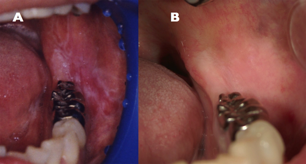 (A) OLP Lesions Affecting the Bilateral Buccal Mucosa (January 1995), (B) Disappearance of OLP (May 2011) (A) OLP Lesions Affecting the Bilateral Buccal Mucosa (January 1995), (B) Disappearance of OLP (May 2011)