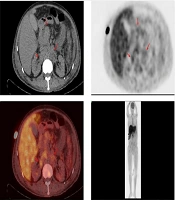 Can Talaromyces marneffei Infection Cause Acute Liver Failure? A Case Report