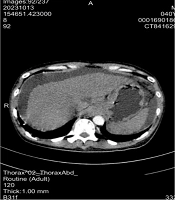 Diagnosis and Treatment of Acute-on-Chronic Liver Failure Caused by HIV/HBV Co-infection: A Case Report