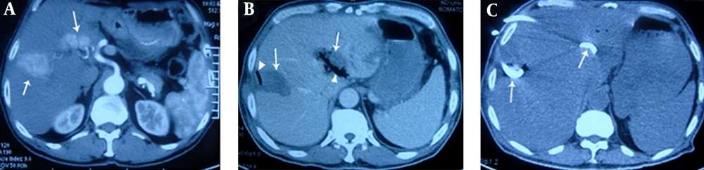 A 66-Year-Old Patient With Multiple Tumors Who Underwent RFA Via Percutaneous Puncture A, contrast-enhanced transverse CT obtained during the arterial phase shows irregular liver tumors (arrows) with maximum diameters of 4.6 cm and 3.5 cm, in liver segments VII and II, respectively. The latter tumor is located in the porta hepatis; B, on the 6th postoperative day, the patient underwent CT due to fever and chills. CT showed gas (triangular mark) forming in the low-attenuation ablation zone (arrow), indicating formation of a liver abscess. Cultures from puncture aspiration were positive <i>for Escherichia coli</i>; C, in addition to treatment with carbapenem antibiotics, catheter drainage (arrows) by percutaneous puncture under ultrasonic guidance was administered, and pus was aspirated. Four weeks later, the patient had recovered.