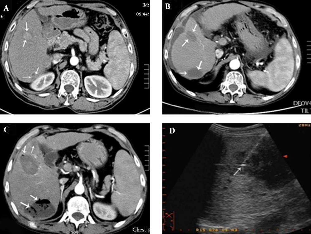 Patient with Child-Pugh Class-C Cirrhosis Who Underwent MWA Treatment of Liver Cancer With Percutaneous Puncture A, contrast-enhanced transverse CT imaging shows a 2.8 × 2.1 cm liver tumor (arrow) in segment IV and an irregular tumor (arrow) measuring approximately 2 × 1.5 cm, located close to the top of the right kidney in segment VI; B, after MWA, contrast-enhanced transverse CT imaging showed an oval low-density lesion (arrows); C, three days after the operation, hyperpyrexia occurred, with body temperature reaching 39.0°C. One week after the operation, contrast-enhanced CT showed an expanded ablation zone with pneumatosis, suggesting the formation of a liver abscess (arrows); D, catheter drainage of the liver abscess.