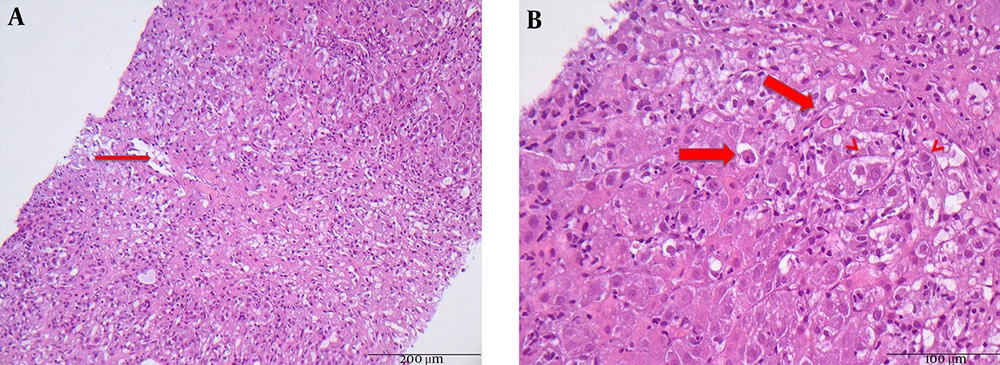Representative Hematoxylin and Eosin (H & E)-Stained Histopatholic Slides A, Severe hepatitis with bridging necrosis is demonstrated. Arrow indicates central vein (original magnification × 200); B, Arrows indicate apoptotic bodies. Arrow heads indicate hepatocytes with severe cell swelling (original magnification × 400).