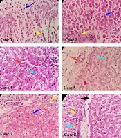 Liver Histopathology of Deceased Patients with COVID-19: A Case Series from Tehran, Iran