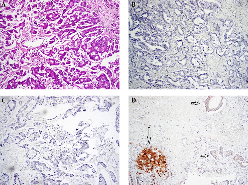 A, Sections Show Metastatic Adenocarcinoma From Colon (H & E x100); B, Arginase Staining Shows Negative Cytoplasm; C, Glypican Shows Negative Cytoplasm; D, A Case of Metastatic Adenocarcinoma of Colon Which Shows Weak Positivity of the Metastatic Glands, Horizontal Arrow (Compare With Intense Staining With the Normal Liver, Vertical Arrow) A, Sections Show Metastatic Adenocarcinoma From Colon (H & E x100); B, Arginase Staining Shows Negative Cytoplasm; C, Glypican Shows Negative Cytoplasm; D, A Case of Metastatic Adenocarcinoma of Colon Which Shows Weak Positivity of the Metastatic Glands, Horizontal Arrow (Compare With Intense Staining With the Normal Liver, Vertical Arrow)
