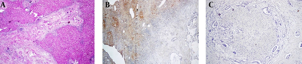 A, Sections From Cholangiocarcinoma (H & Ex100); B, Arginase Staining Shows Negative Cytoplasm (Note the Intense Staining of the Normal Liver (Vertical Arrow) in the Vicinity of Negative Glands (Horizontal Arrow); C, Glypican Shows Negative Cytoplasm A, Sections From Cholangiocarcinoma (H & Ex100); B, Arginase Staining Shows Negative Cytoplasm (Note the Intense Staining of the Normal Liver (Vertical Arrow) in the Vicinity of Negative Glands (Horizontal Arrow); C, Glypican Shows Negative Cytoplasm