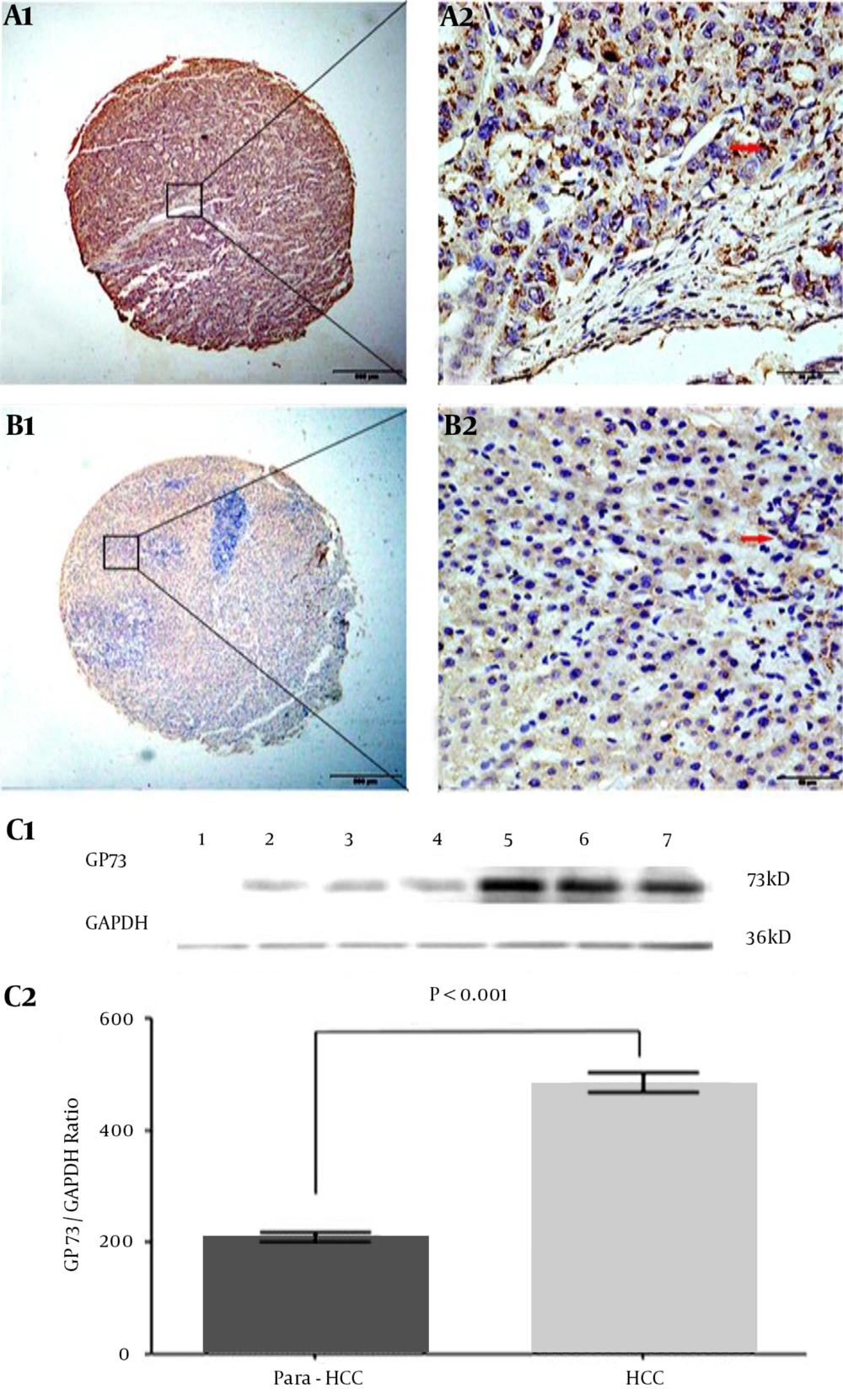 Characteristics of Liver GP73 Expression and Cellular Distribution The brown GP73 expressions of liver tissues were stained by tissue microarray using immunohistochemical technology. A1 and A2, the GP73 expression in poorly differentiated HCC tissue; B1 and B2, the GP73 expression in well-differentiated HCC tissue. Original magnification × 40 in A1 and B1 or × 400 in A2 and B2; as a negative control, the second goat anti-rabbit antibody without pre-staining for specific GP73 monoclonal antibody did not give any significant background staining. In HCC tissues, the positive cells were often localized in periportal areas. GP73: Golgi protein 73; HCC: hepatocellular carcinoma. C1, the GP73 expression of different tissues was confirmed by Western blotting. Lane 1: the control liver tissue; Lanes 2–4: the non-cancerous tissues; Lanes 5 - 7: the HCC tissues; GP73, GP73 protein (73 kD); GAPDH, glyceraldehyde-phosphate dehydrogenase (36 kD) as a control. C2, the above stripe grey values of GP73 protein were relatively quantitated in HCC or their non-cancerous tissues.