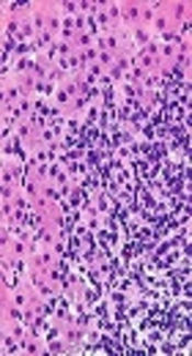 Cover image of the article: IFN-γ siRNA Effectively Knocked Down IFN-γ Gene Expression and Reduced Cytokine Secretion in Peripheral Blood Mononuclear Cells of Patients with Autoimmune Hepatitis