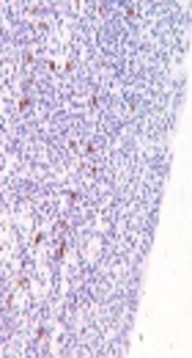 IgG4 Status in Explanted Livers Does Not Affect the Outcome of Primary Sclerosing Cholangitis (PSC) After Liver Transplant