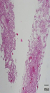 Immunohistochemical Classification of Hepatic Adenoma, A Single Center Experience