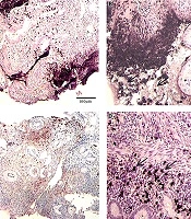 Characteristics of Hemorheology in Patients with Acute Severe Ulcerative Colitis and the Clinical Study of Rivaroxaban Anticoagulant Therapy