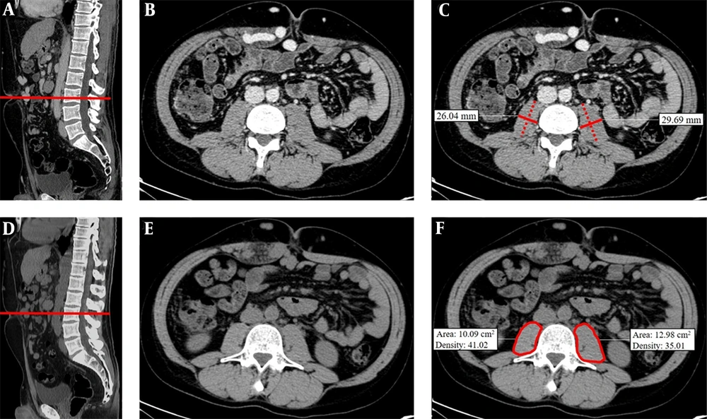 Transversal psoas muscle thickness. (A) In a sagittal CT image passing through the spinal column, the red line was positioned at the umbilicus to obtain a single axial image (B). (C) Transversal psoas muscle thickness measurement (dotted line) was perpendicular to the axial psoas muscle thickness measurement, which corresponds to the largest diameter of the psoas muscle on an axial view (continuous line). Cross-sectional psoas muscle area and psoas muscle density. (D) In a sagittal CT image, the red line was positioned at L3 to obtain a single axial image (E). (F) Psoas muscle profile was contoured using the free-hand density measurement tool. Thanks to this instrument, both psoas muscle area and density were simultaneously calculated. All the measurements were performed on the right and left psoas muscle. Transversal psoas muscle thickness. (A) In a sagittal CT image passing through the spinal column, the red line was positioned at the umbilicus to obtain a single axial image (B). (C) Transversal psoas muscle thickness measurement (dotted line) was perpendicular to the axial psoas muscle thickness measurement, which corresponds to the largest diameter of the psoas muscle on an axial view (continuous line). Cross-sectional psoas muscle area and psoas muscle density. (D) In a sagittal CT image, the red line was positioned at L3 to obtain a single axial image (E). (F) Psoas muscle profile was contoured using the free-hand density measurement tool. Thanks to this instrument, both psoas muscle area and density were simultaneously calculated. All the measurements were performed on the right and left psoas muscle.