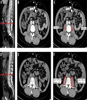 Pre-transplant Psoas Muscle Density as a Ready-to-Use and Low-cost Predictor of Patient Survival After Liver Transplant