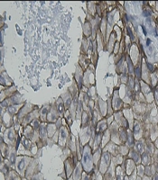 Accuracy of Digital Image Analysis (DIA) of Borderline Human Epidermal Growth Factor Receptor (HER2) Immunohistochemistry in Invasive Ductal Carcinoma