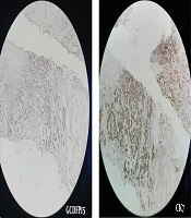 Breast and Axillary Metastasis with Colon Cancer Primary Origin