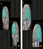 Computed Tomography/Magnetic Resonance Imaging (CT/MRI) Image Registration and Fusion Assessment for Accurate Glioblastoma Radiotherapy Treatment Planning