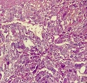 An Unusual Presentation of Choriocarcinoma: A Case Report with a Long Latent Period