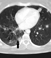Choriocarcinoma with Uterine Rupture in a Patient with Confirmed COVID-19 Infection: A Rare Case Report