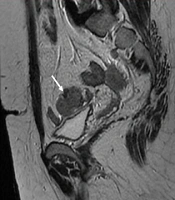 Cutaneous Metastasis in a Previously Known Case of Ovarian Dysgerminoma: A Case Report