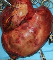 A Cardiac Approach to Wilms Tumor with Tumor Thrombus Extension to the Right Atrium Without Cardiopulmonary Bypass: A 5-Year Follow-up