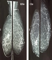 Radiation-induced Stromal Sarcoma of Breast: A Case Report and Literature Review
