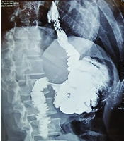 Cover image of the article: Ileocolic Interposition as a Gastric Substitute in Patients with Total Gastrectomy; Case Series and Literature Review