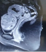 Female Adnexal Tumor of Wolffian Origin Presenting as Paratubal / Broad Ligament Masses: A Case Report