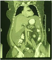 A Struma Ovarii Associated with Pseudo-Meigs’ Syndrome is Misdiagnosed as Advanced Ovarian Cancer: A Case Report