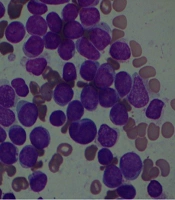 Successful Chemotherapy of an Acute Myeloid Leukemia Case Infected with SARS-CoV-2