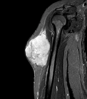 Primary Extraosseous Ewing Sarcoma of the Upper Limb: Report of a Rare Case