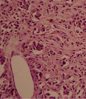 Primary Malignant Melanoma of Uterine Cervix with Disseminated Involvement of Lower Genitourinary Tract