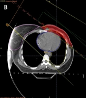 Comparison of 3D-Conformal Planning Using Partially Wide Tangents and Direct Photon/Electron Portals for Breast Radiotherapy with Internal Mammary Nodes Inclusion: A Dosimetric Analysis