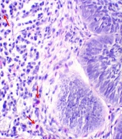 Comparative Study of Immune Cells Infiltration in Cutaneous Squamous Cell Carcinoma and Basal Cell Carcinoma of the Head and Neck