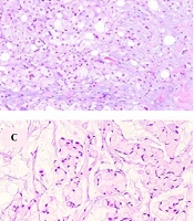 Metastatic Breast Signet-Ring Cell Carcinoma from a Colonic Primary: Review of a Rare Case Report