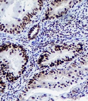 Cover image of the article: Prevalence of DNA Mismatch Repair Deficiency in Endometrial Cancer Using Immunohistochemistry