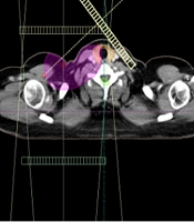 Evaluation of the Radiobiological Models Predicting the Radiation-Induced Hypothyroidism in the Partially Irradiated Thyroid Gland of Patients with Breast Cancer