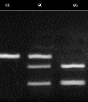 Investigation of Cyclooxygenase-2 Gene Polymorphism in Patients with Gastric Cancer and Healthy Individuals in Northern Iran