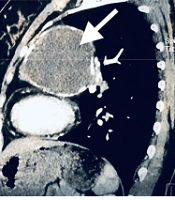 A Case Report of Intrapulmonary Mature Cystic Teratoma of the Lung