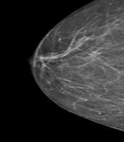 Diagnostic Approach to Developing Asymmetry in Opportunist Screening Mammography; Correlation of Ultrasound, Magnetic Resonance Imaging, and Histopathologic Findings with Developing Asymmetry: A Cross-sectional Study