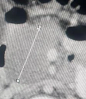 Acute Pancreatitis as a Rare and Unusual Manifestation of COVID-19 in a Child with Acute Lymphoblastic Leukemia
