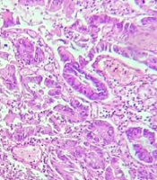 The Role of P21 Protein Expression in Predicting Progression and Biological Behaviors of Gastric Adenocarcinomas