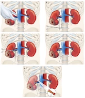 Tactile Ligation Technique for Renal Vascular Control During Open Radical Nephrectomy