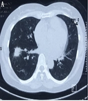 Cover image of the article: Weekly Afatinib in the Treatment of Advanced Non-small Cell Lung Cancer with EGFR-G719C Mutation Followed by Lobectomy: A Case Report