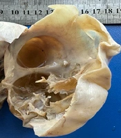 A Rare Case of Struma Ovarii in Afghanistan