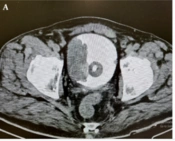 Cover image of the article: Two-Stage Radical Cystoprostatectomy in a Complicated Patient: A Case Report