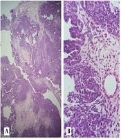 Adult Uterine Wilm’s Tumor Miss-interpreted as Carcinosarcoma: A Case Report