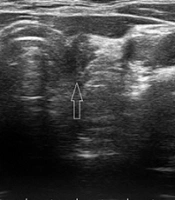 Central Neck Ultrasound: A Single-Center Experience of Its Diagnostic Accuracy After Thyroidectomy in Patients with Thyroid Cancer