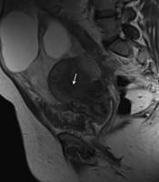 Low Grade Extrauterine Endometrial Stromal Sarcoma Arising from Peritoneum Endometriosis: A Case Report and Literature Review